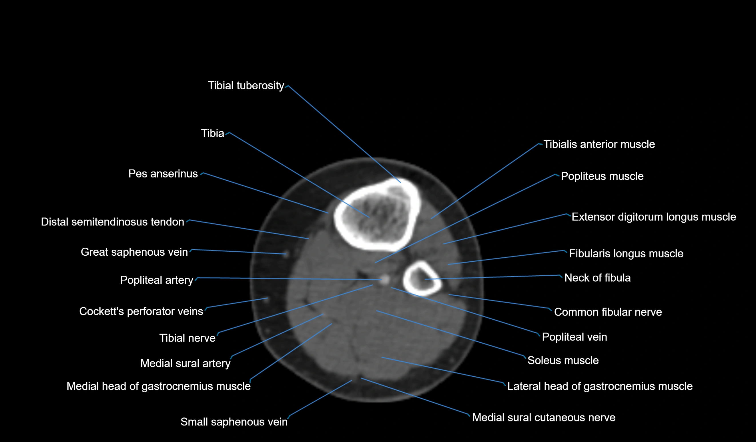 CT knee axial cross sectional anatomy labelled image-00051.webp